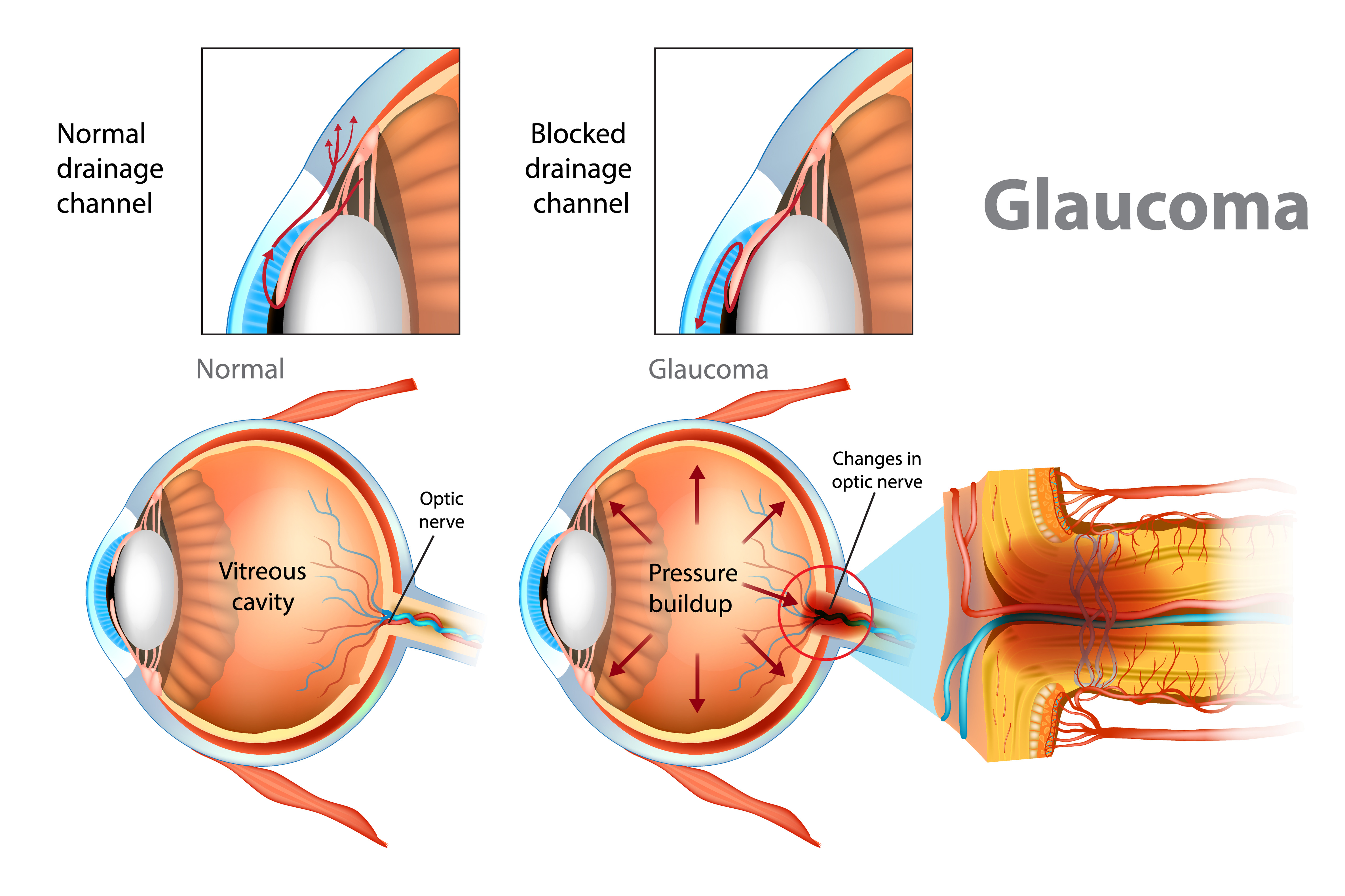 Glaucoma pressure buildup